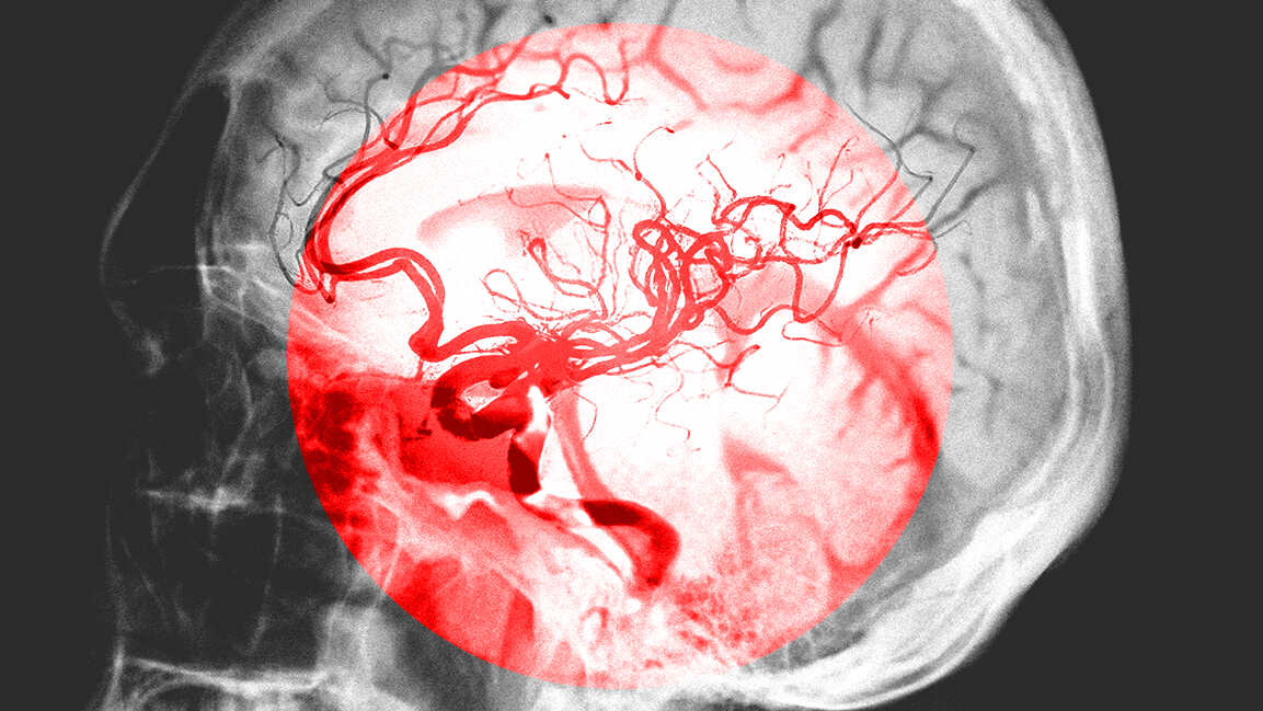 Here’s how Cleveland Clinic Abu Dhabi is innovating brain aneurysm treatment
